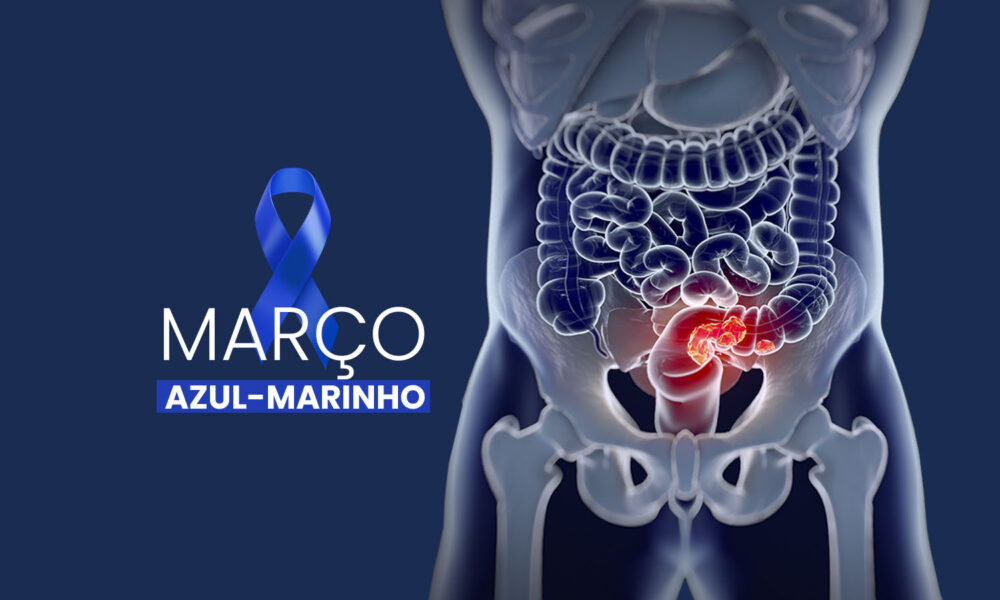 Prevenção do câncer colorretal: Hospital Regional de São José realiza mutirão de colonoscopia.